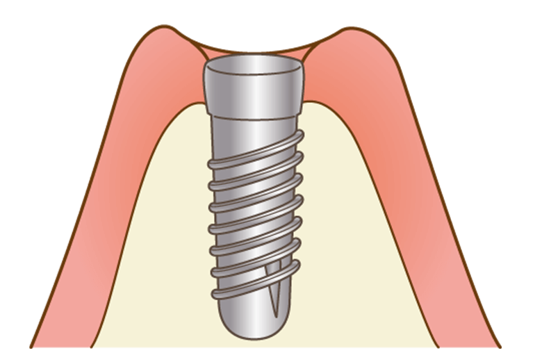 インプラント埋入（一次手術）