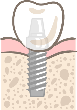 インプラント