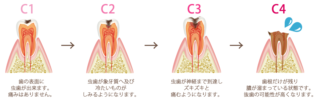 むし歯の原因・進行について